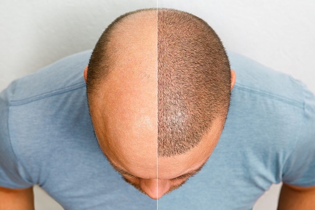 Am I a Good Candidate for Hair Transplant Surgery in Spring, TX & The Woodlands | Dr. Mihail Climov