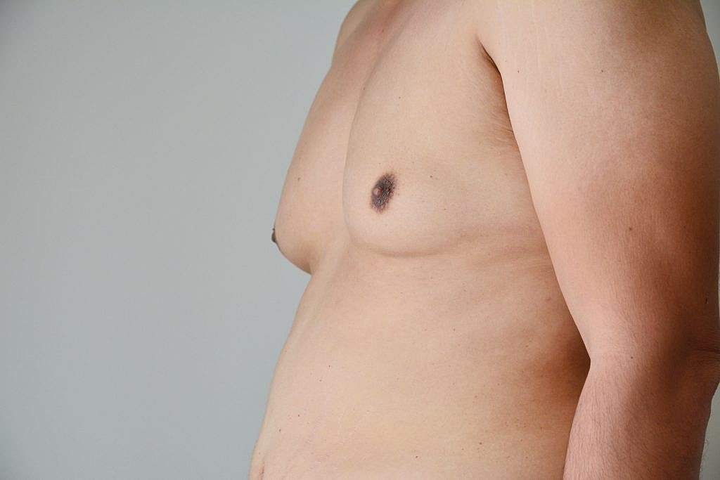 Does Gynecomastia Go Away on Its Own? Understanding Male Breast Enlargement in Spring, TX | Dr. Mihail Climov