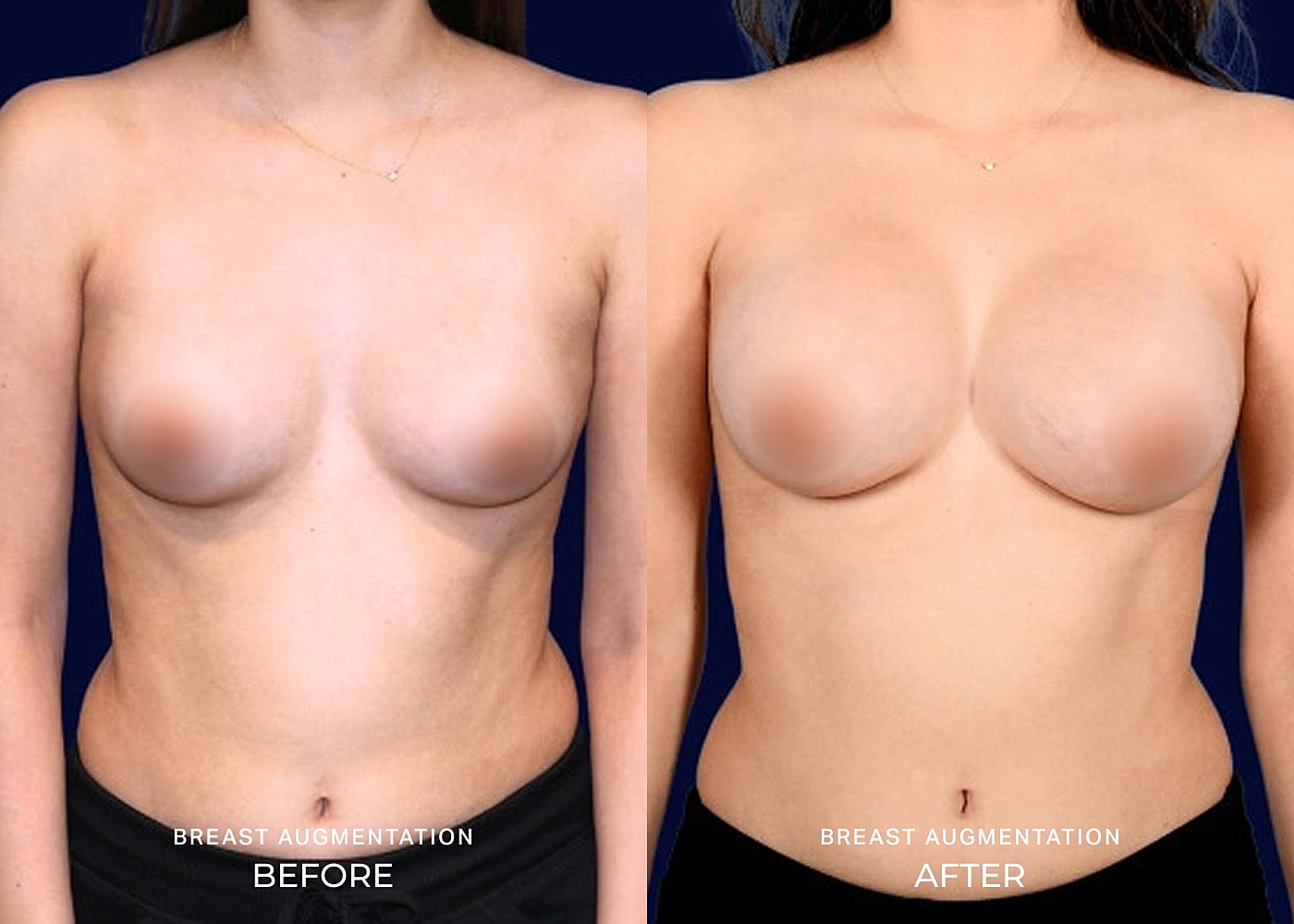 Before and after breast augmentation comparison image.