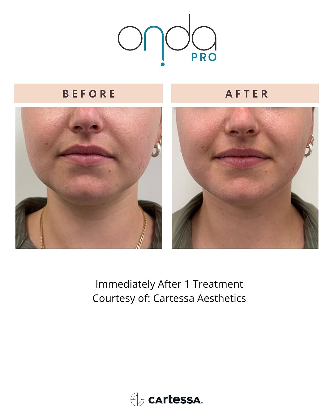 Skin treatment results before and after comparison.