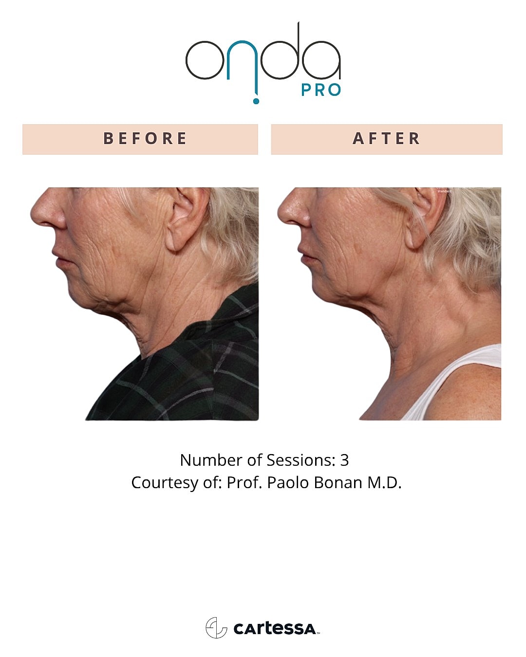 Onda Pro treatment before and after results.