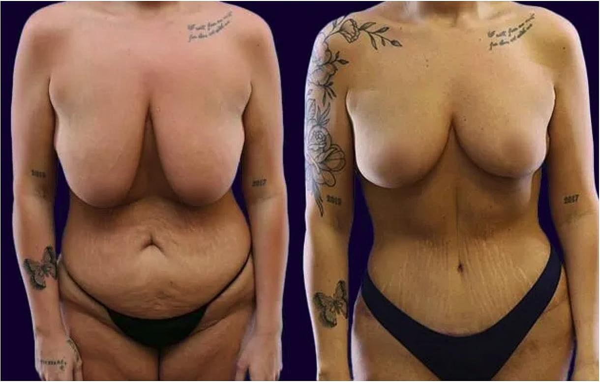 Before and after body transformation photo.