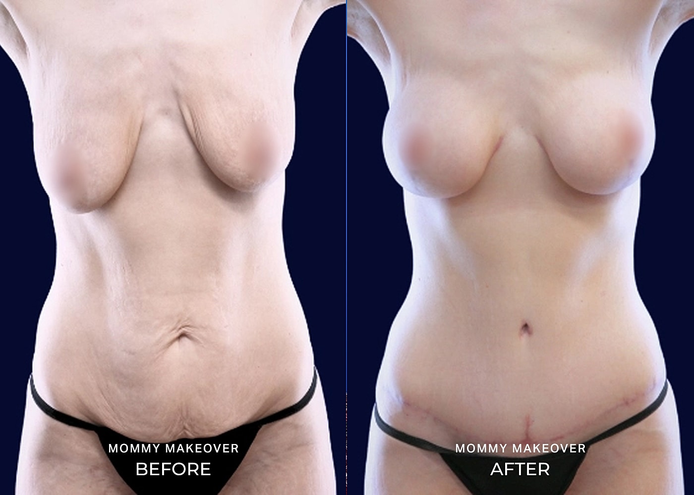 Mommy makeover before and after comparison image