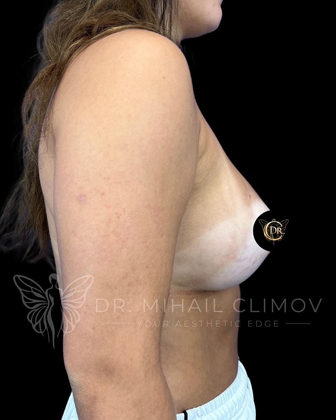 Breast Augmentation Before & After