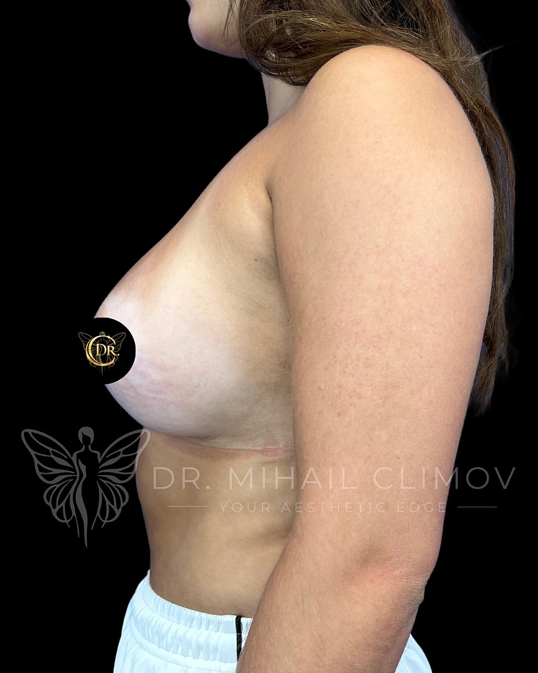 Breast Augmentation Before & After