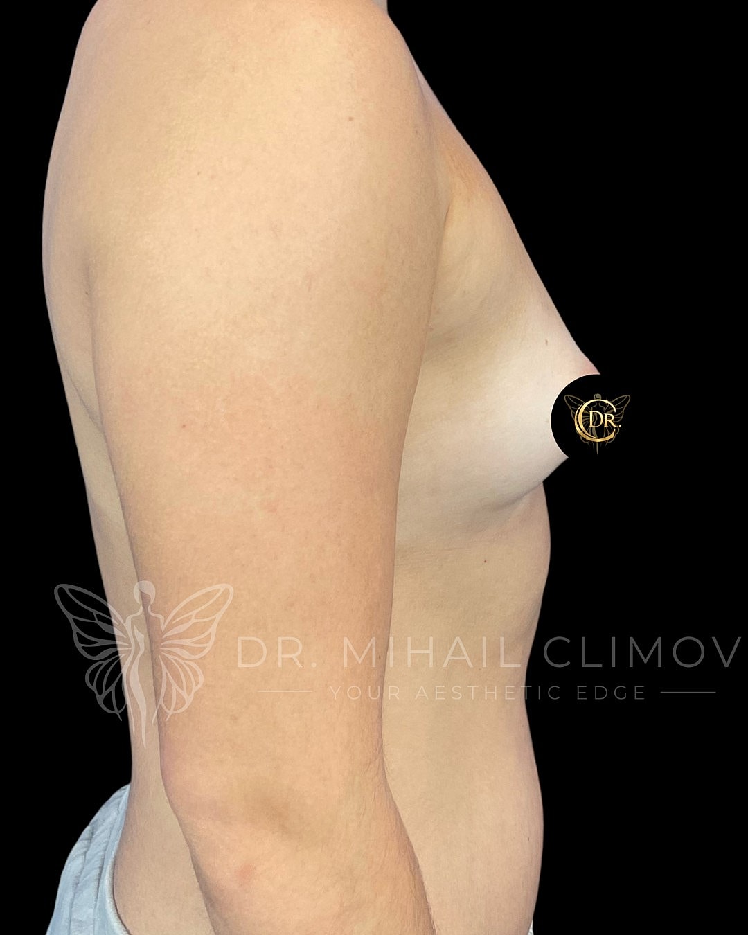 Breast Augmentation Before & After