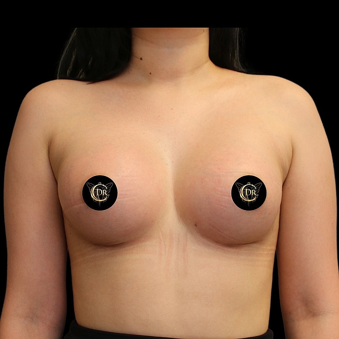 Subfacial Breast Augmentation After Front Right, Case V102
