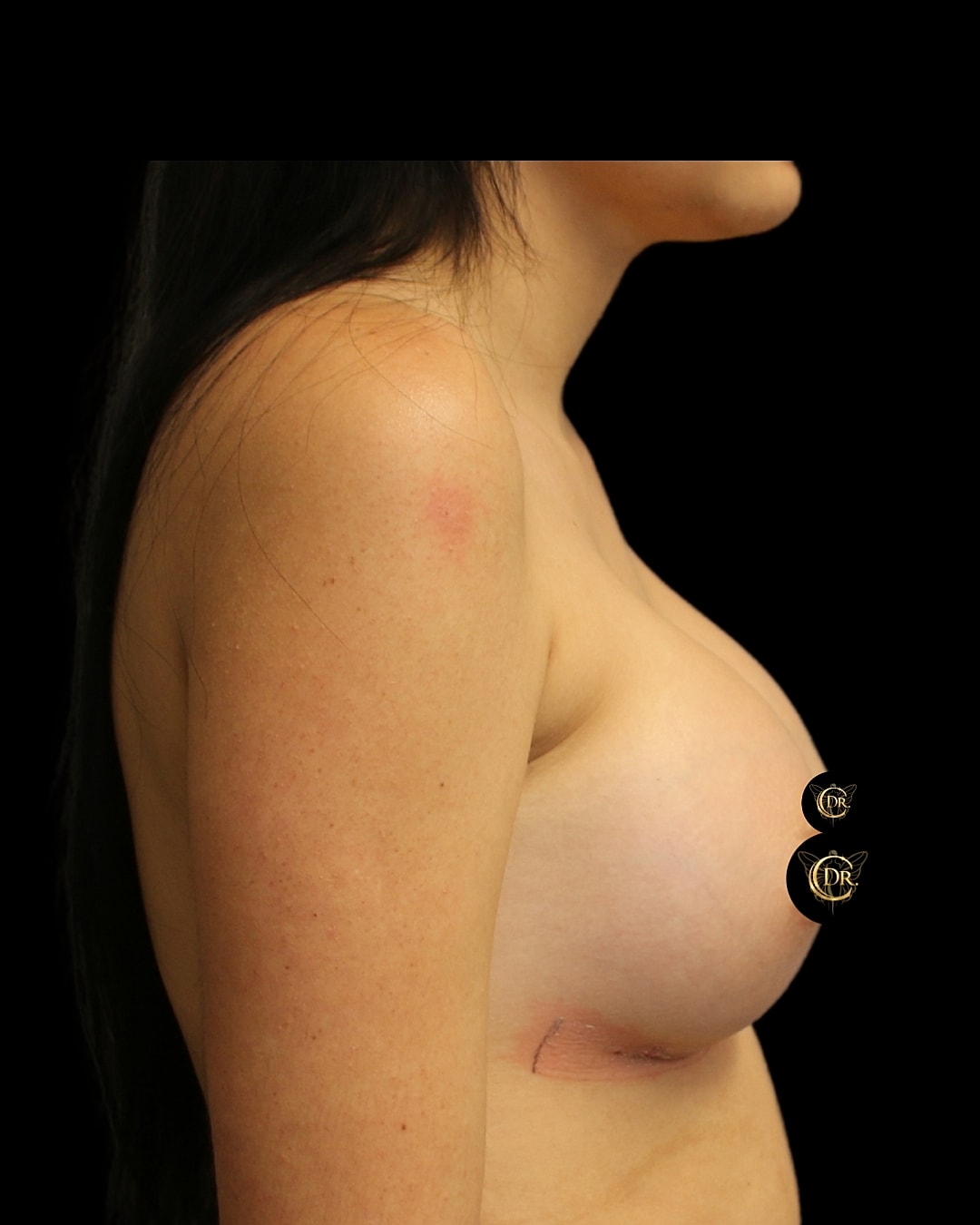 Breast Augmentation Before & After
