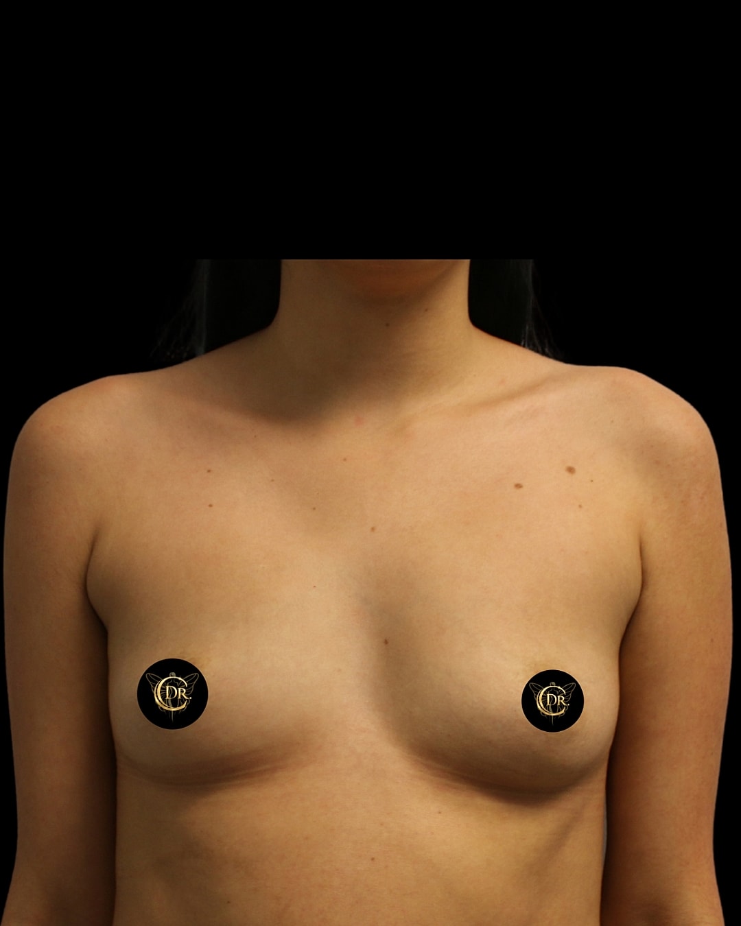 Breast Augmentation Before & After