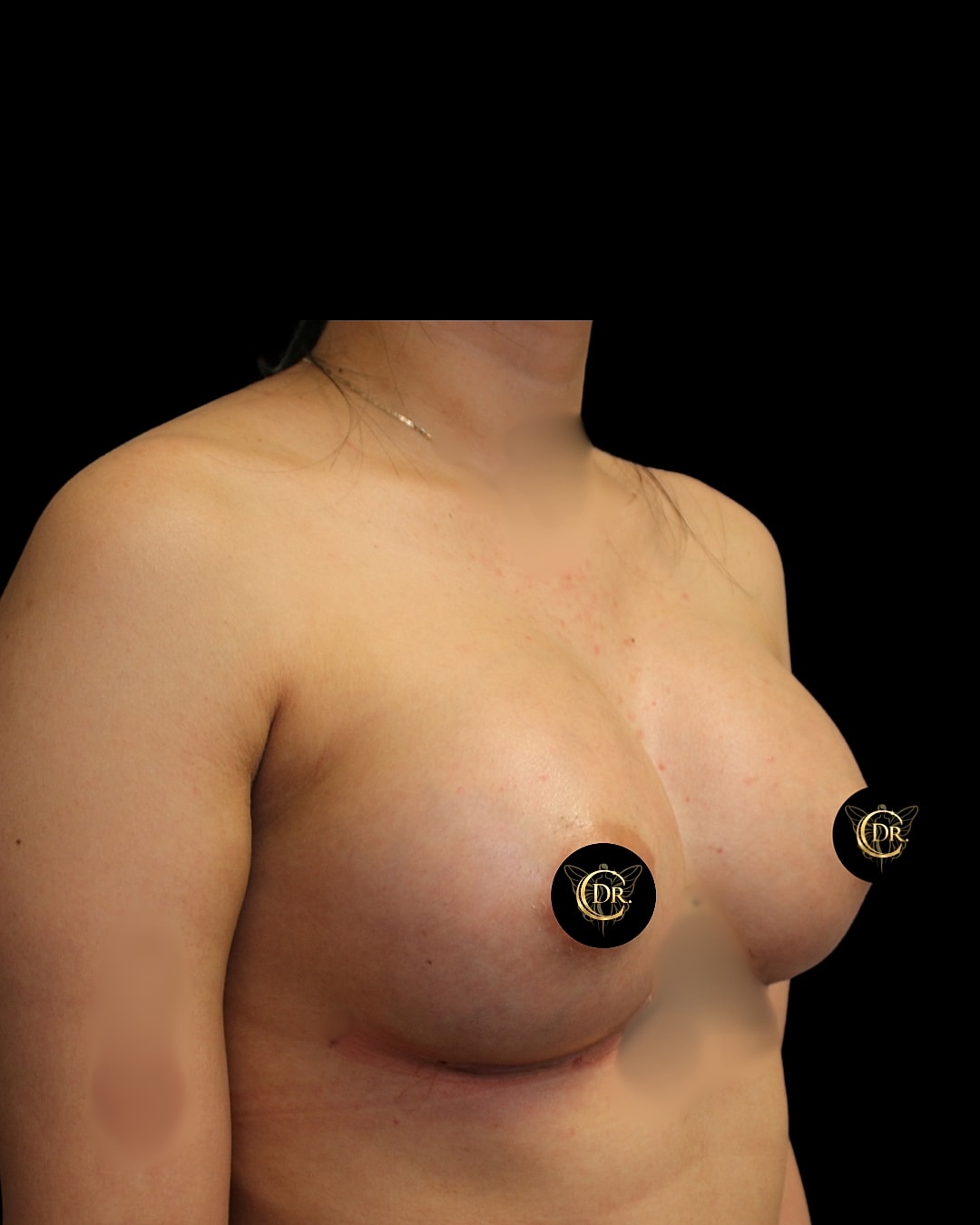 Breast Augmentation Before & After