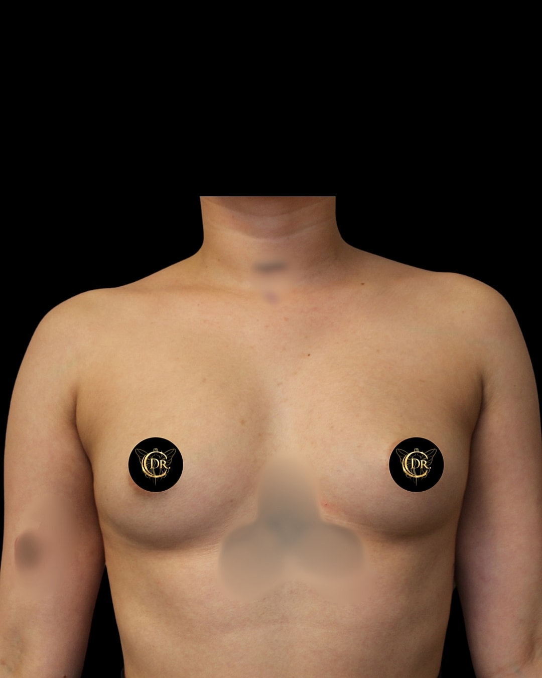 Breast Augmentation Before & After