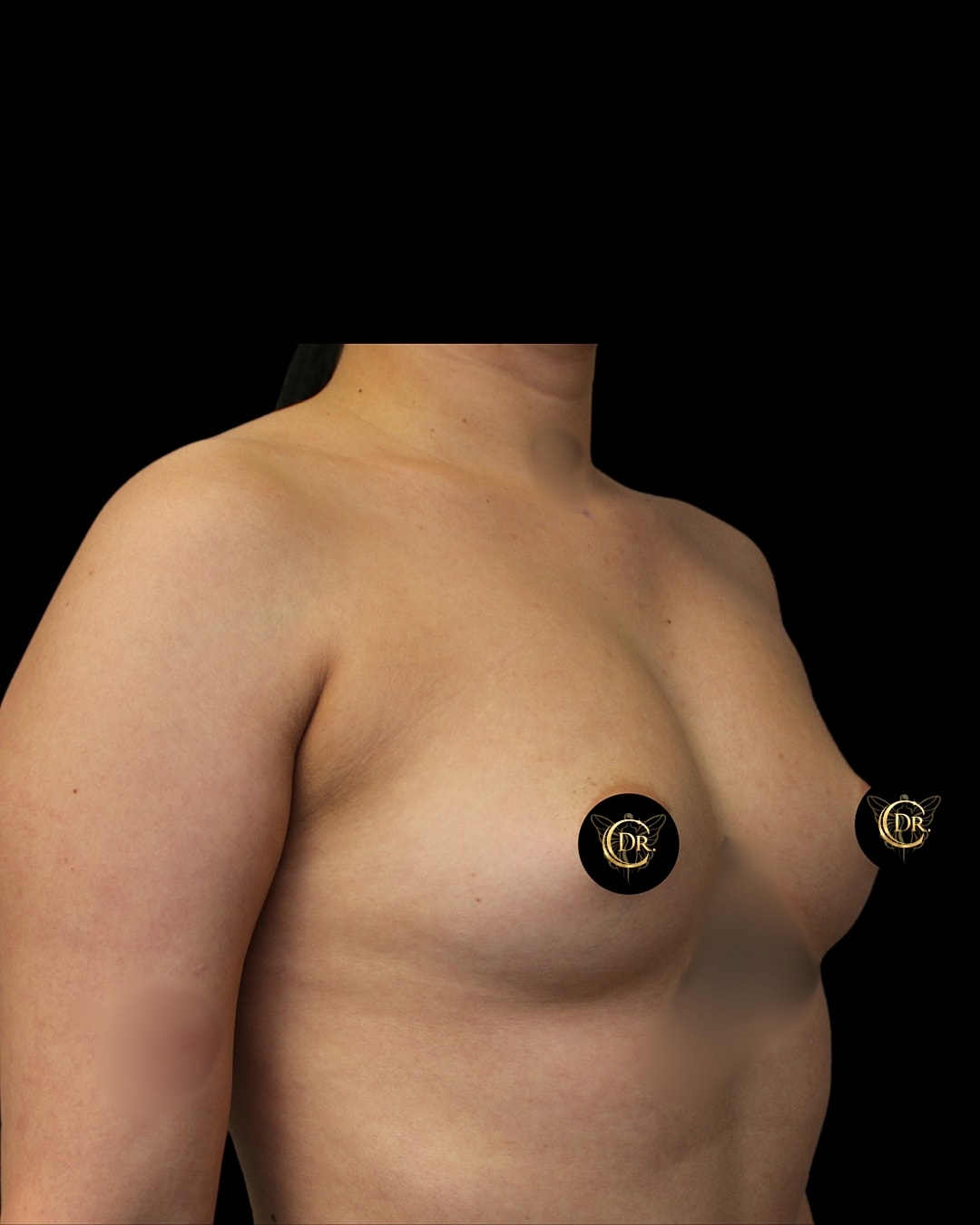 Breast Augmentation Before & After