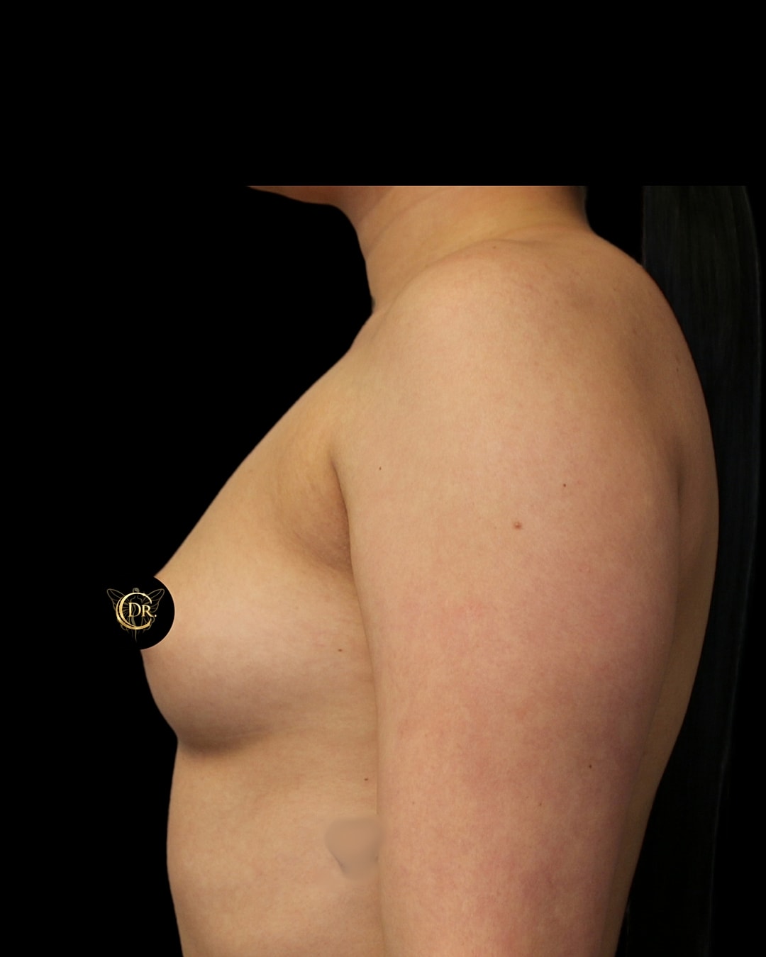 Breast Augmentation Before & After