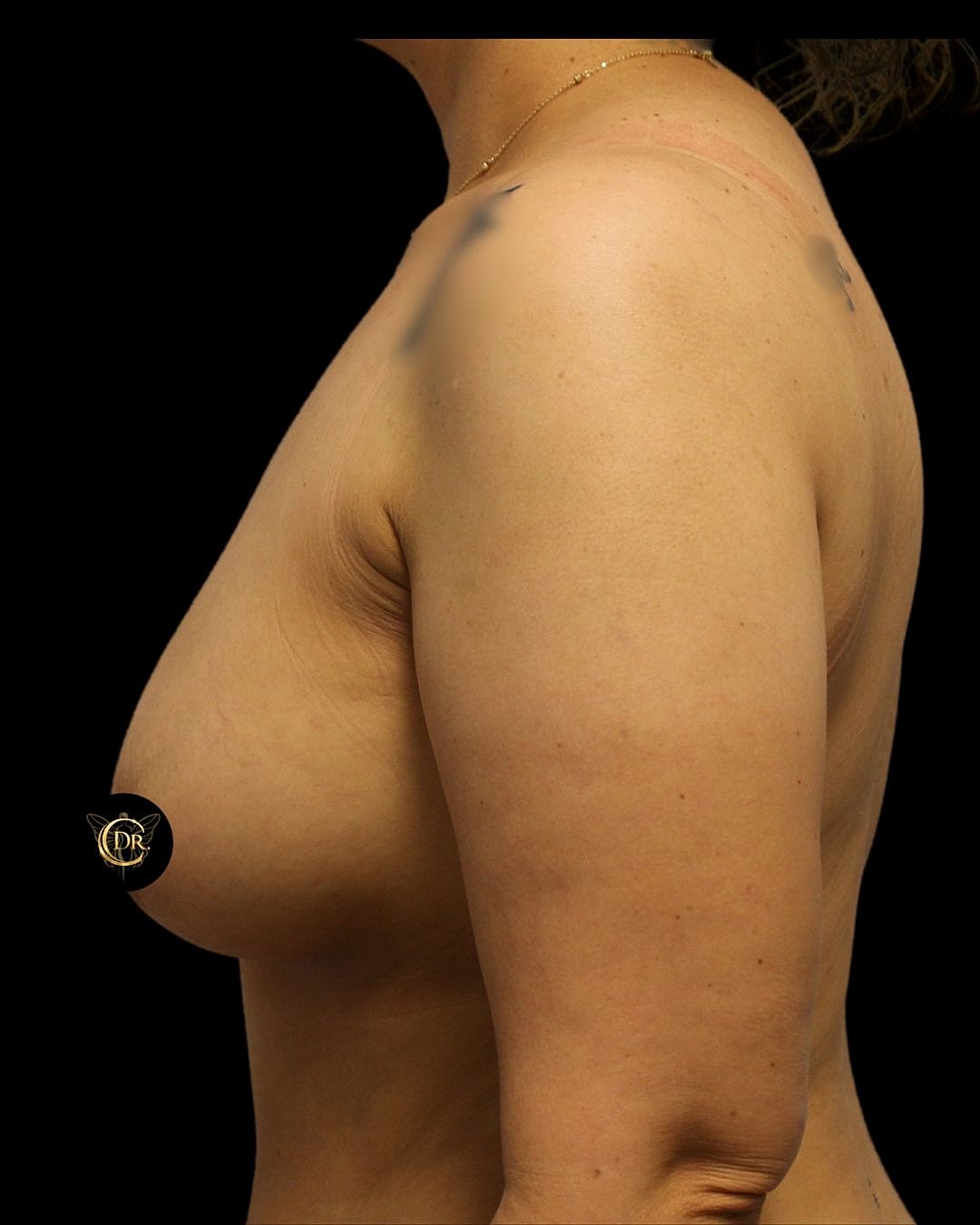 Breast Augmentation Before & After