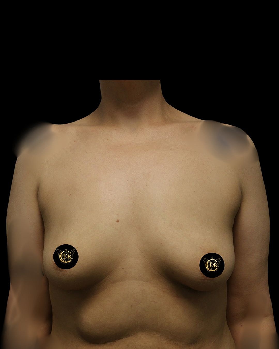Breast Augmentation Before & After