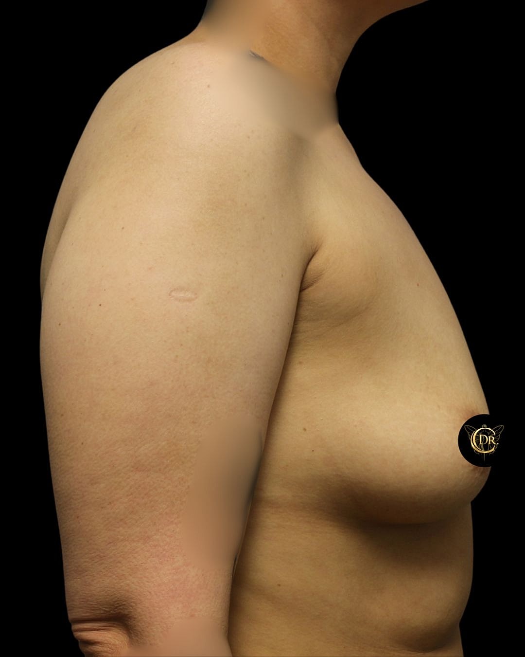 Breast Augmentation Before & After