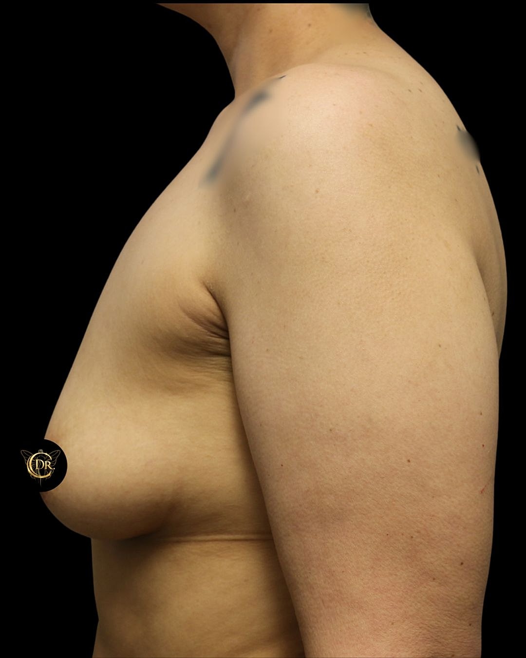 Breast Augmentation Before & After