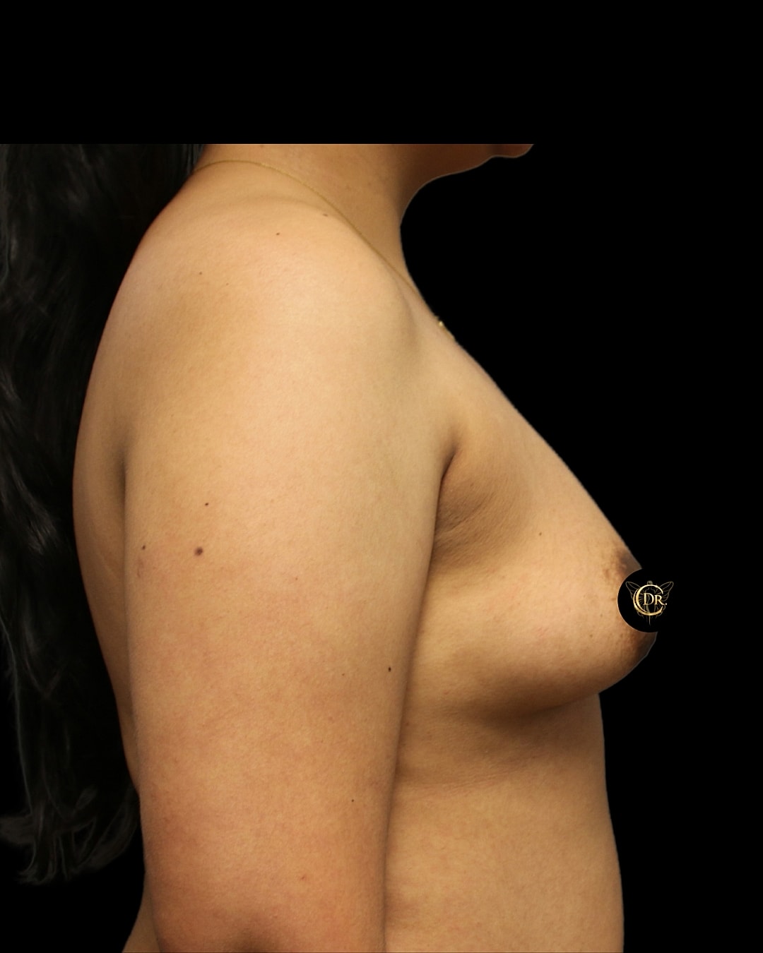 Breast Augmentation Before & After