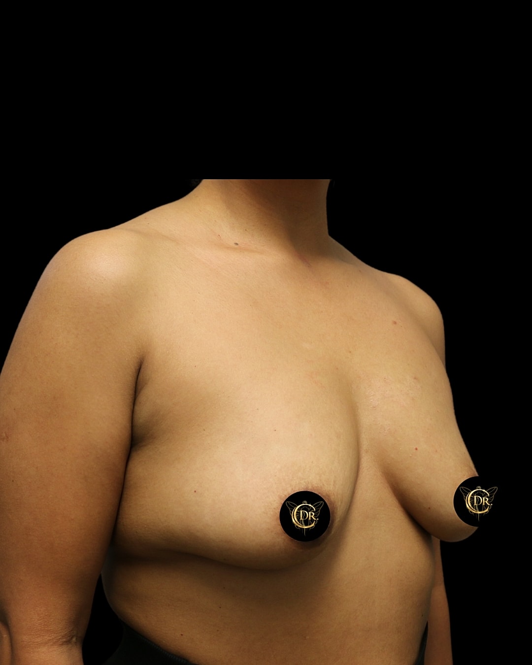 Subfacial Breast Augmentation Before Left Oblique Right, Case V88