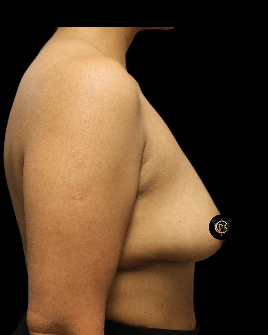 Subfacial Breast Augmentation Before  Left Side, Case V88