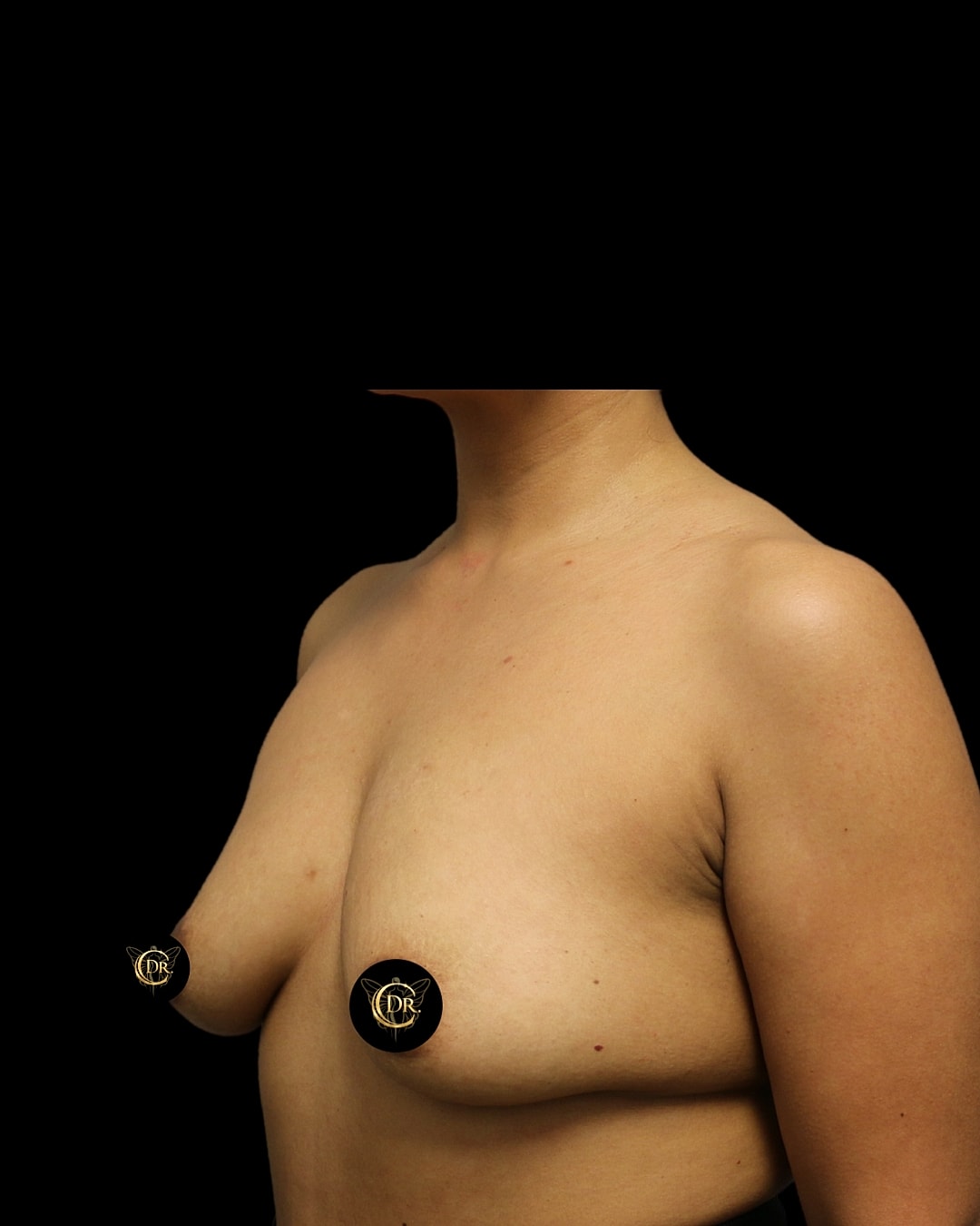 Subfacial Breast Augmentation Before Right Oblique Right, Case V88
