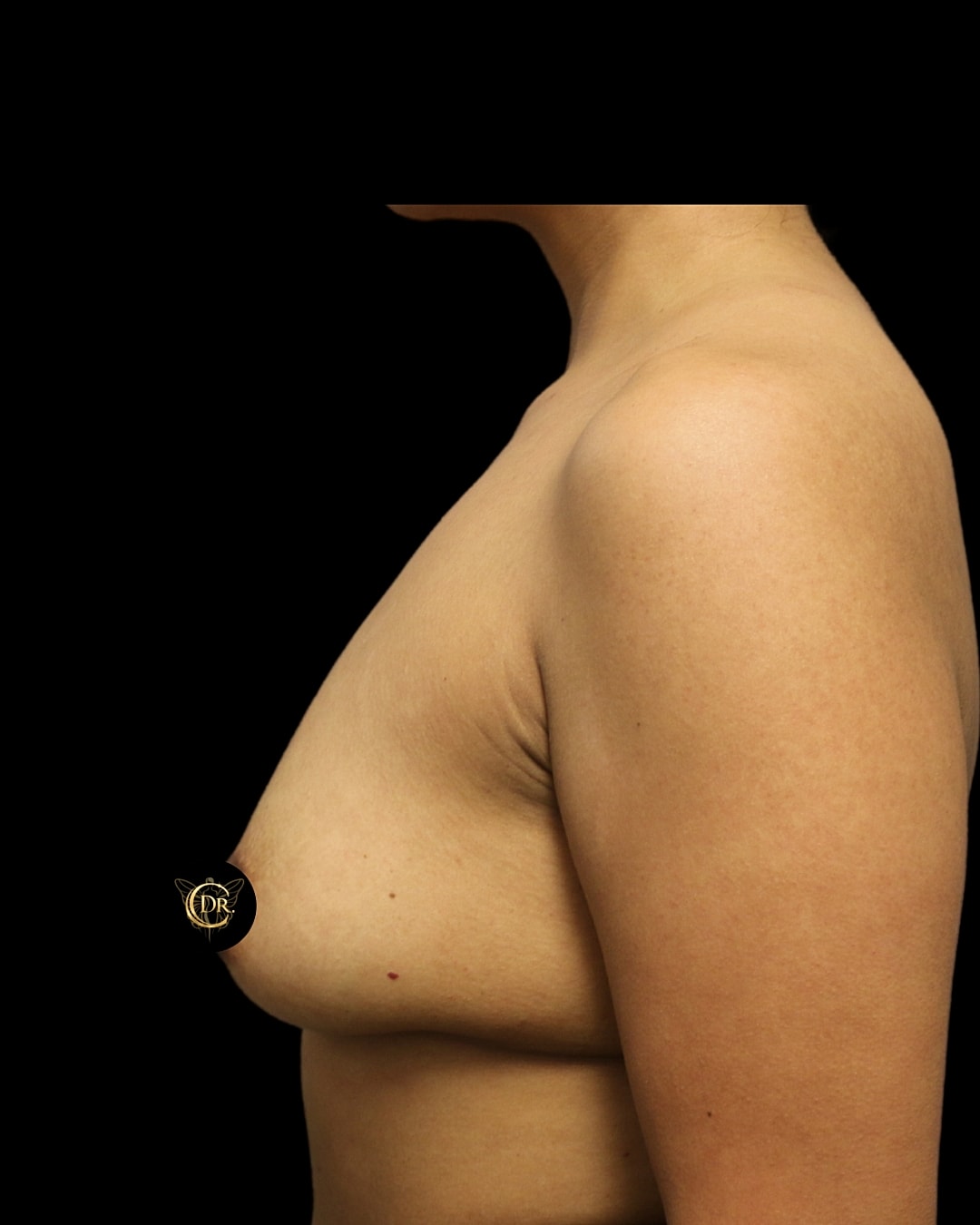 Subfacial Breast Augmentation Before Right Side, Case V88