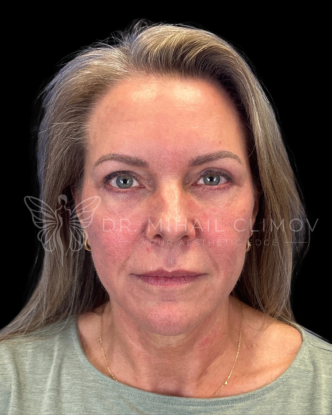 Upper eyelid blepharoplasty after photo, front view, showing crisp lid crease and wide-open refreshed eyes following eyelid lift surgery in Houston, TX.
