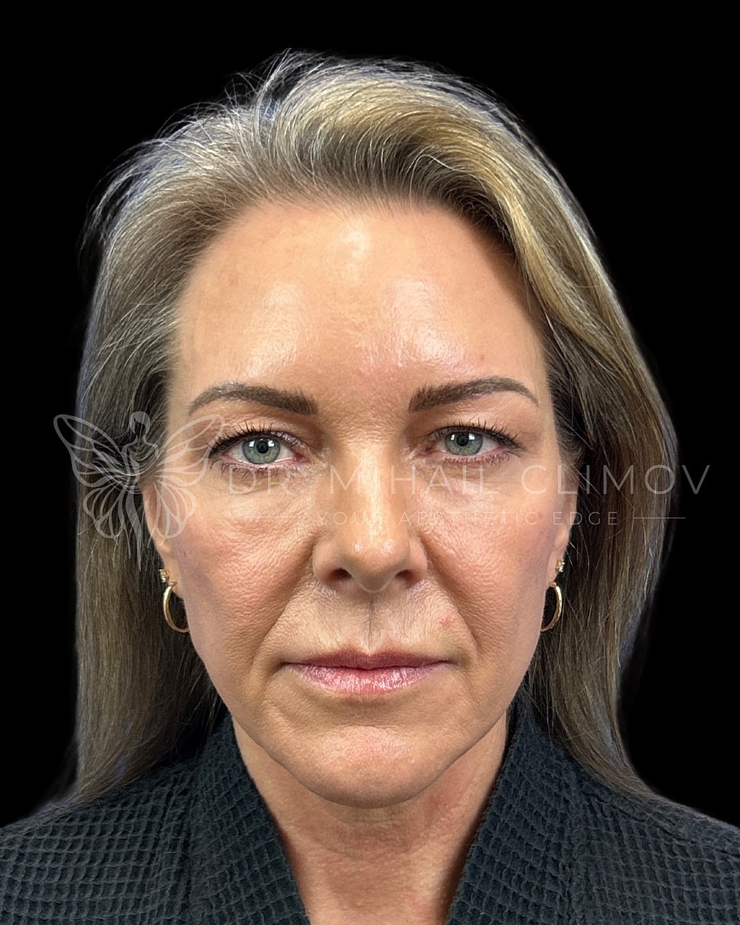 Upper eyelid blepharoplasty before photo, front view, showing redundant upper lid skin and heavy hooding prior to eyelid lift surgery in Houston, TX.