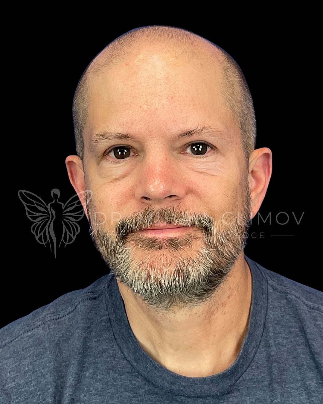 Male upper eyelid blepharoplasty after photo, front view, showing defined lid crease and alert refreshed appearance following cosmetic eyelid surgery in Houston, Texas.