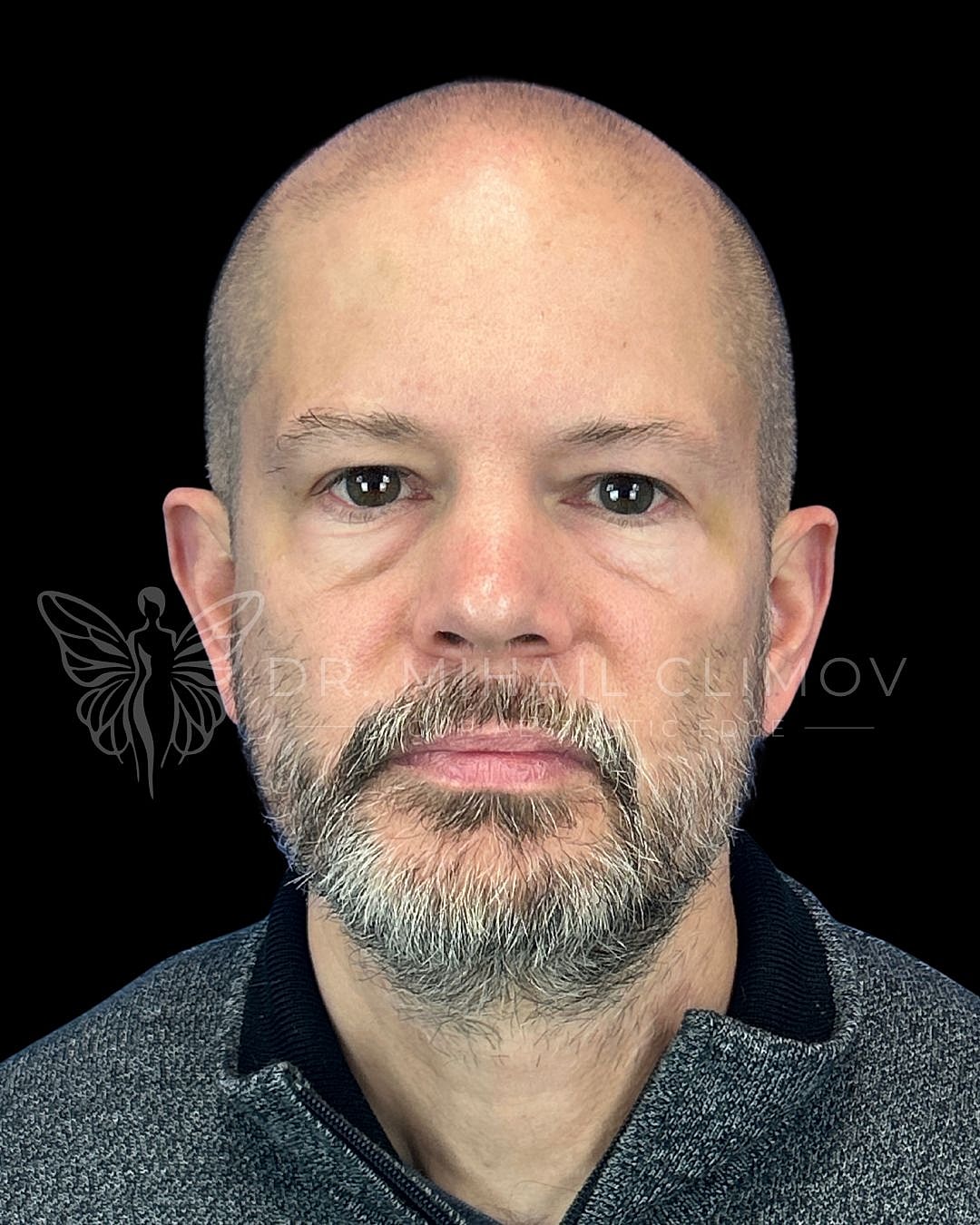 Male upper eyelid blepharoplasty before photo, front view, showing hooded upper lids and excess skin prior to cosmetic eyelid surgery in Houston, Texas.