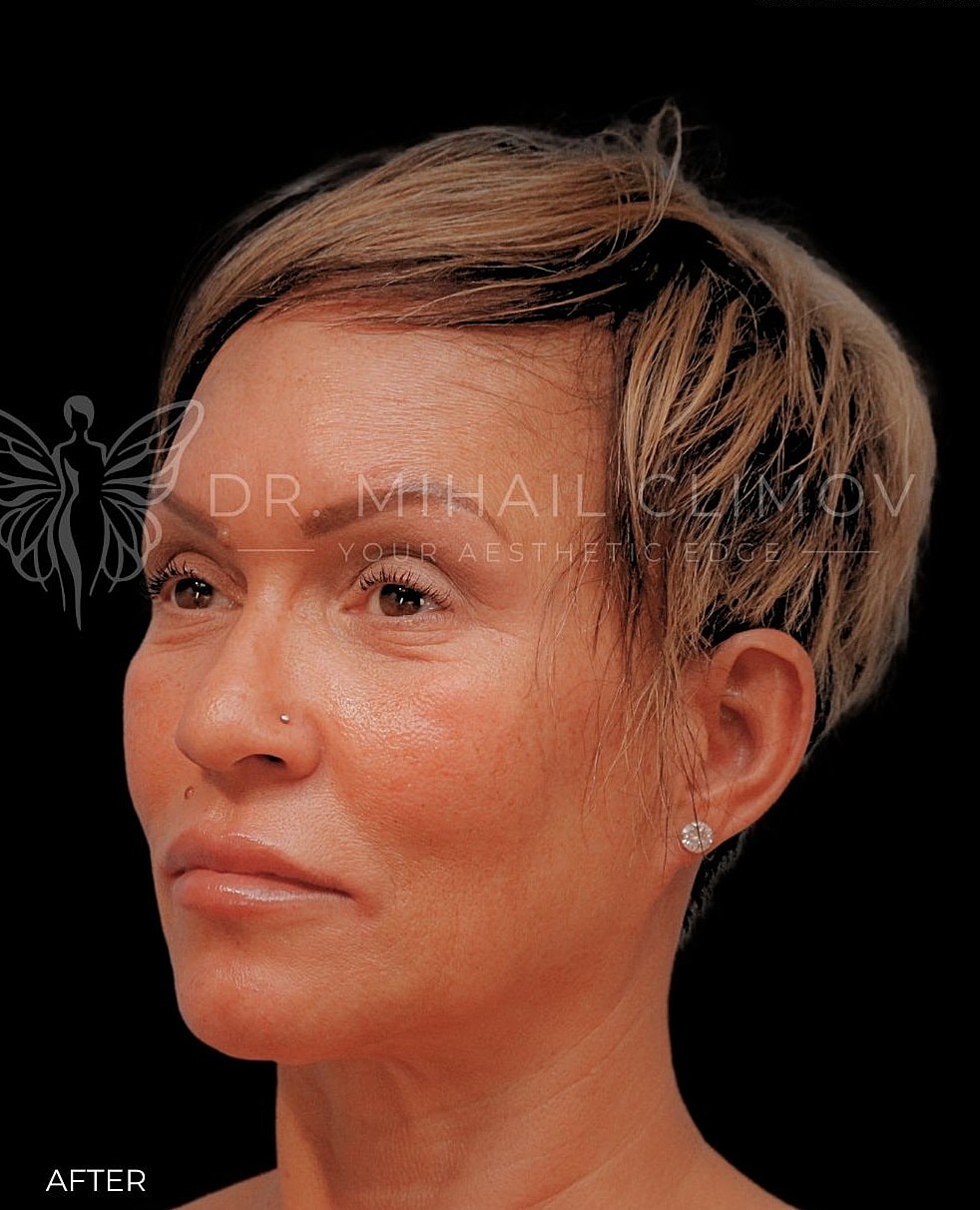 Female upper blepharoplasty after photo, left side view, showing youthful upper lid contour and restored definition following eyelid surgery in Houston, Texas.