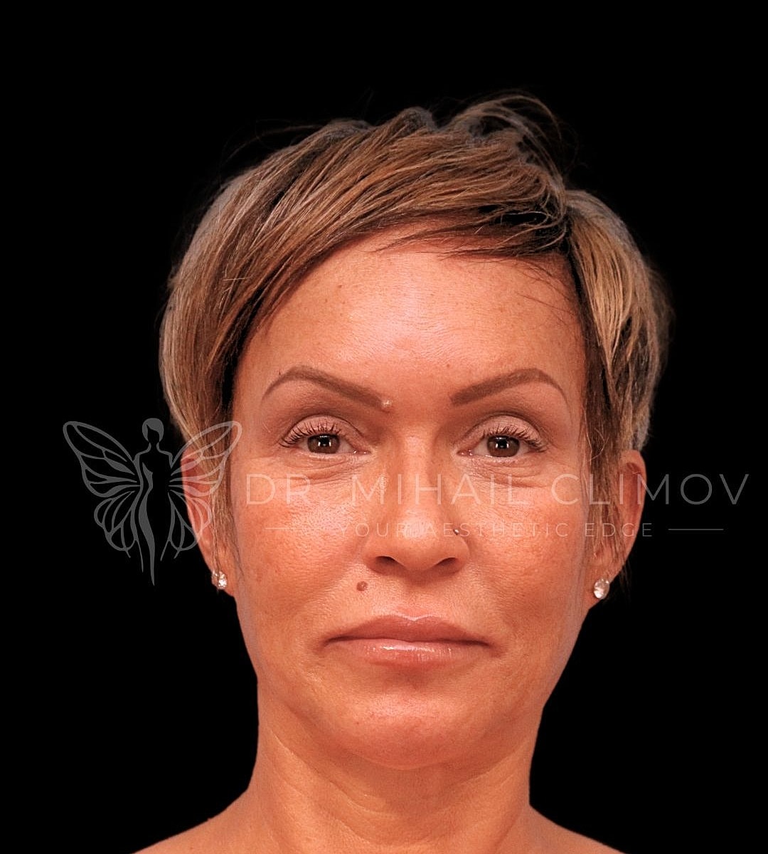 Female upper eyelid blepharoplasty after photo, front view, showing defined lid crease and refreshed appearance following cosmetic eyelid surgery in Houston, Texas.