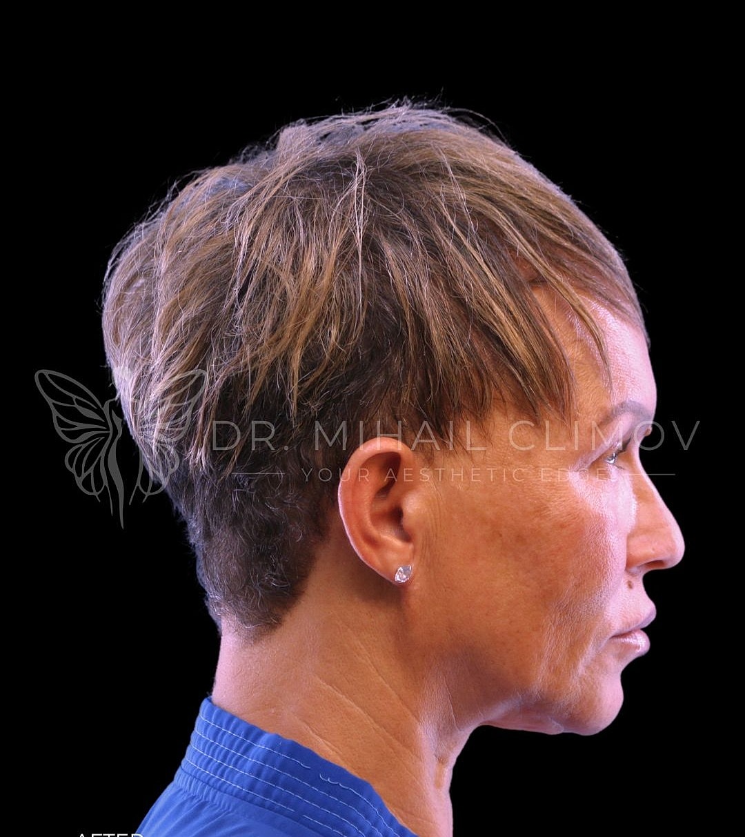 Female upper blepharoplasty after photo, left side view, showing youthful upper lid contour and restored definition following eyelid surgery in Houston, Texas.