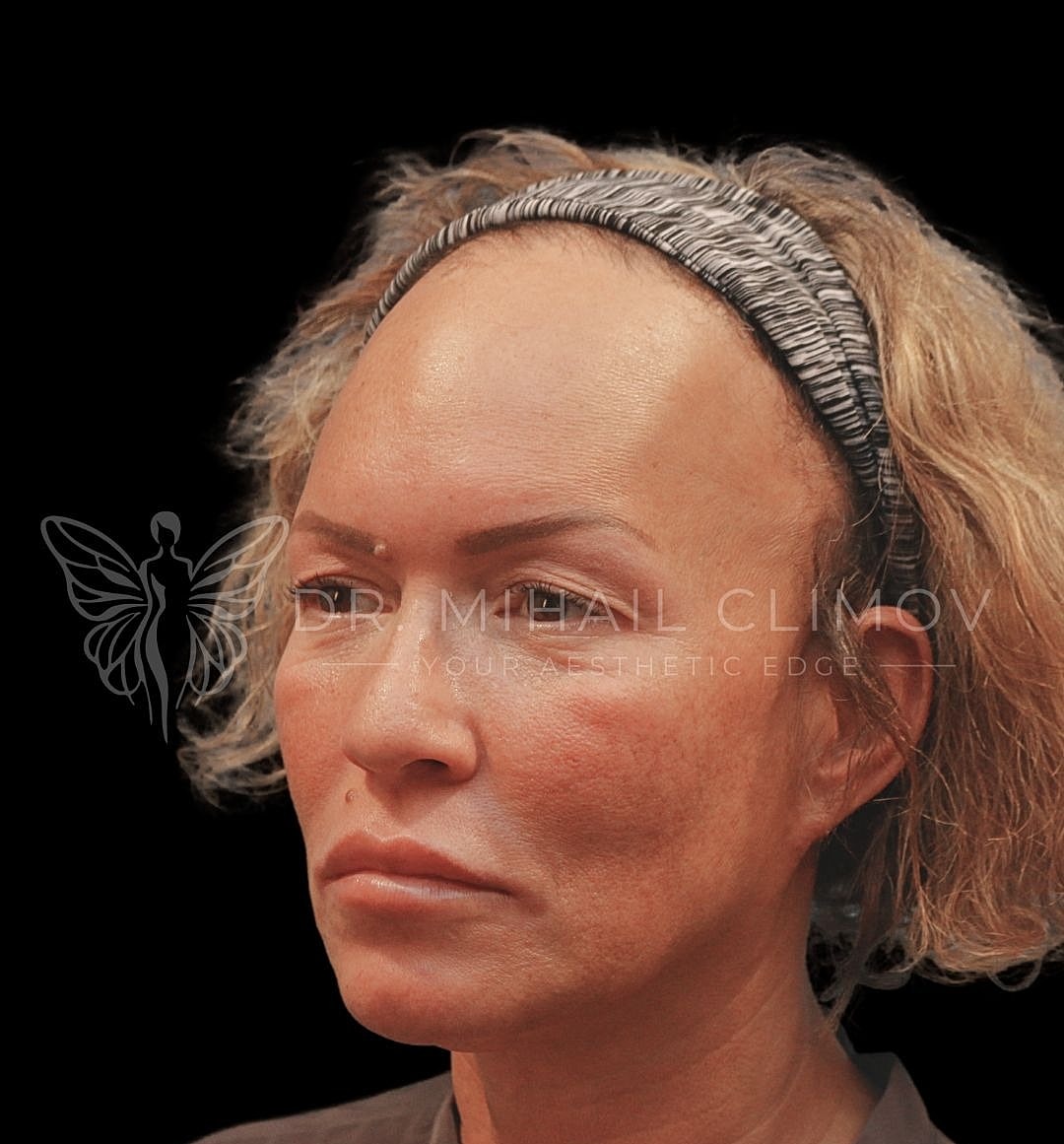 Female upper eyelid blepharoplasty before photo, right oblique view, showing heavy upper lids and lateral hooding prior to cosmetic eyelid surgery in Houston.