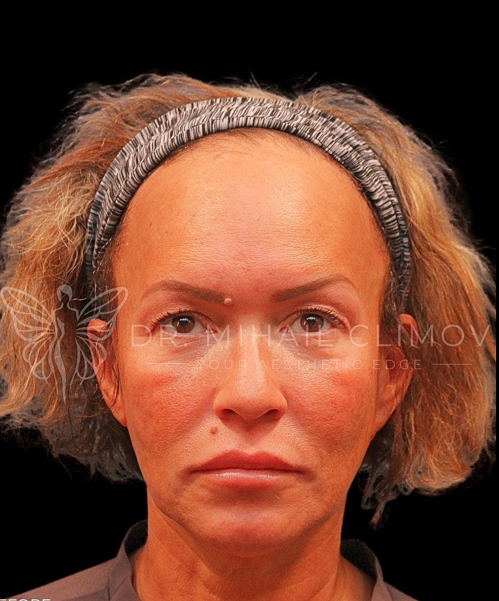 Female upper blepharoplasty before photo, front view, showing sagging upper eyelid skin and tired appearance prior to eyelid surgery in Houston, TX.