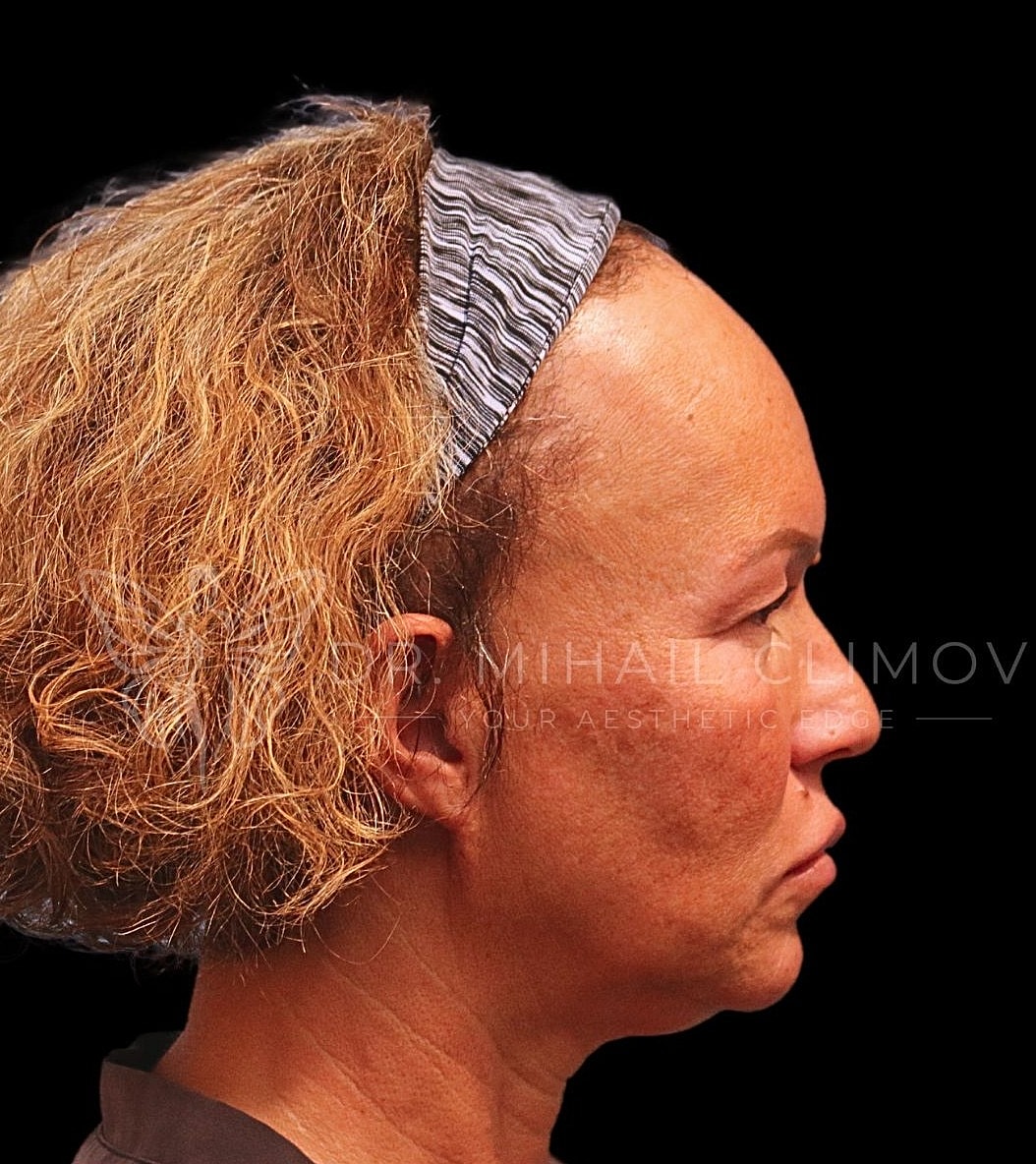 Female upper blepharoplasty before photo, left side view, showing sagging upper eyelid skin and tired appearance prior to eyelid surgery in Houston, TX.