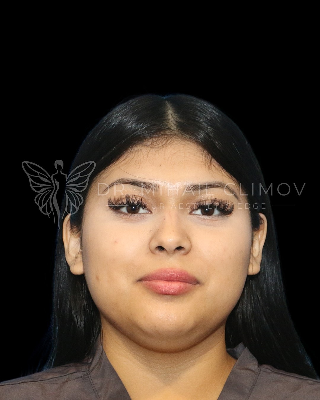 Buccal Fat Removal Before Front, Case A16