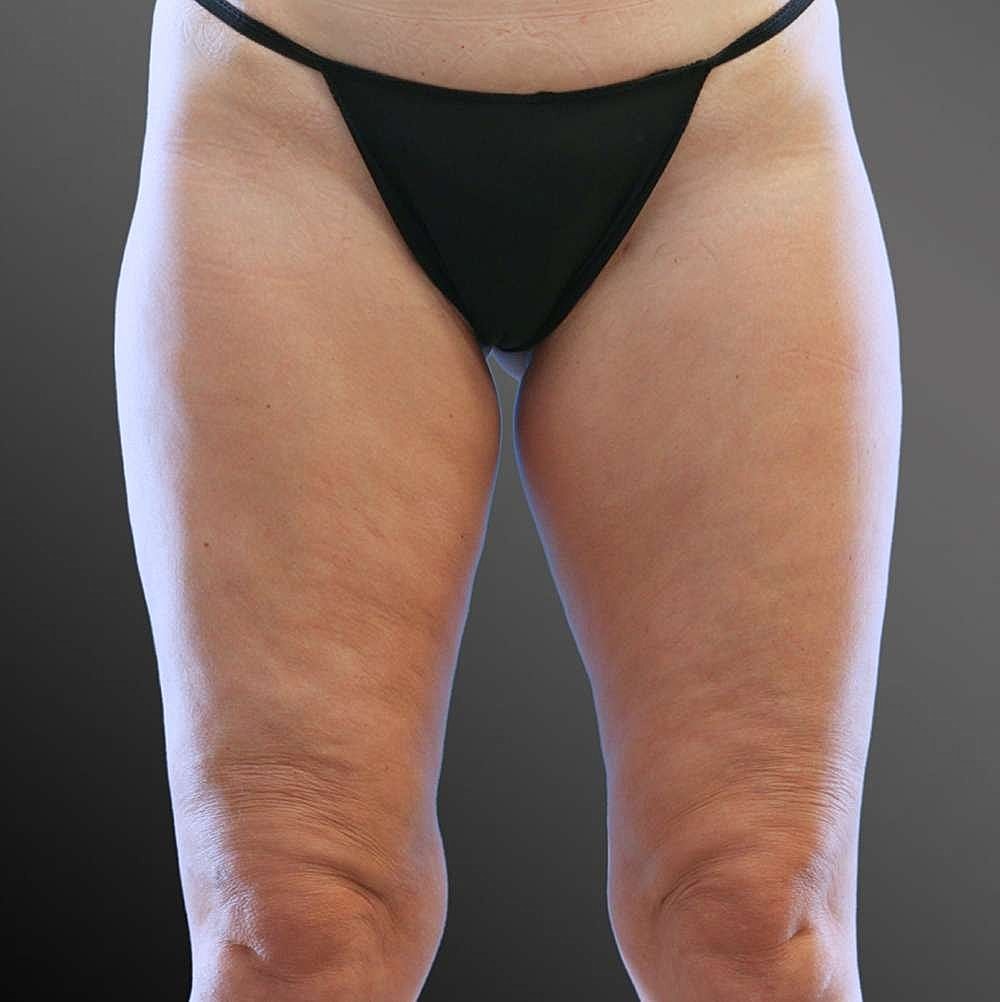 Thigh Contouring Before & After