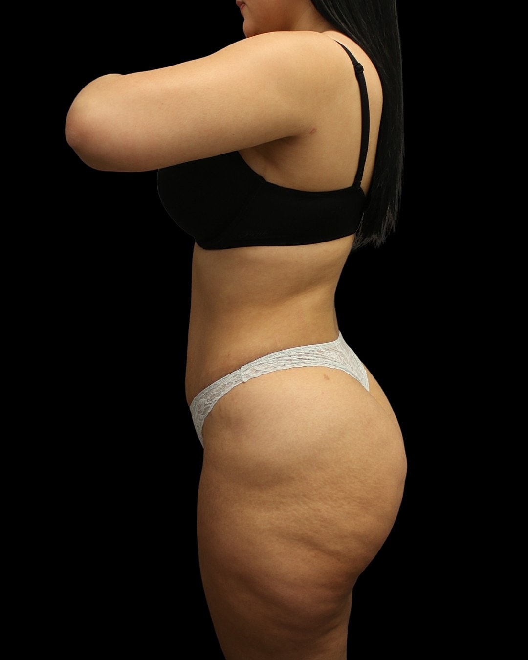 Brazilian Butt Lift Before & After