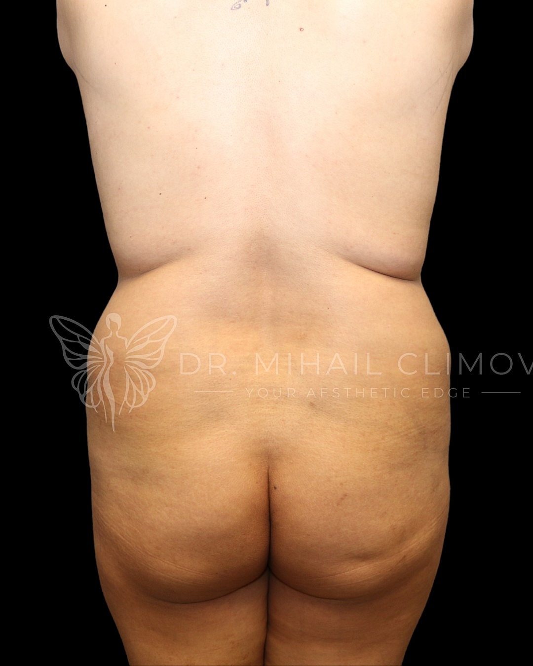 Brazilian Butt Lift Before & After