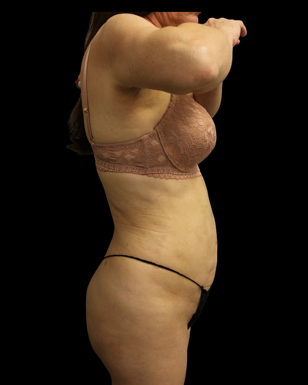 Brazilian Butt Lift Before & After
