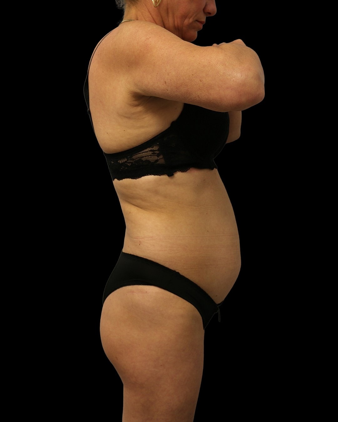 Brazilian Butt Lift Before & After