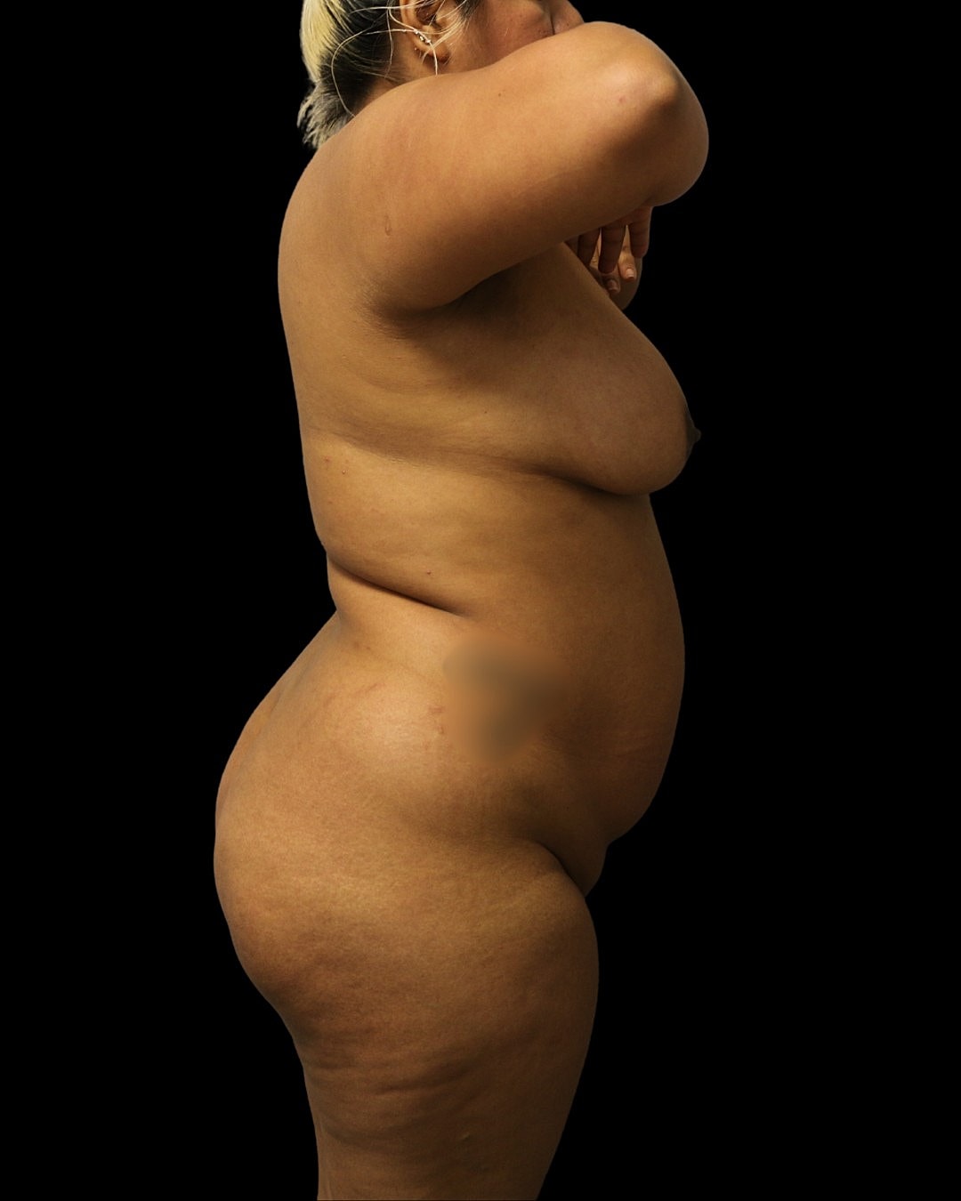 Brazilian Butt Lift Before & After