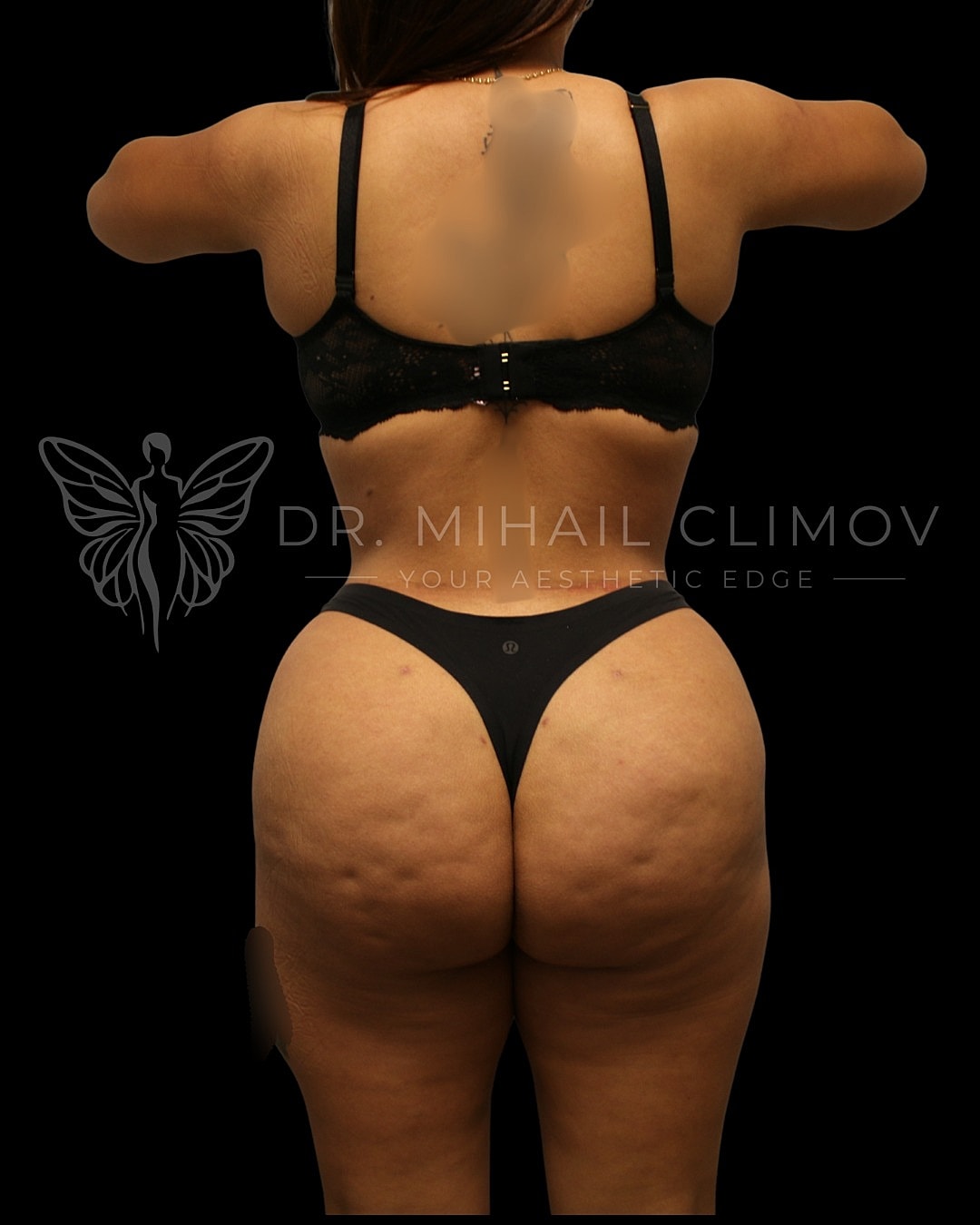 Before and after body contouring treatment photo.