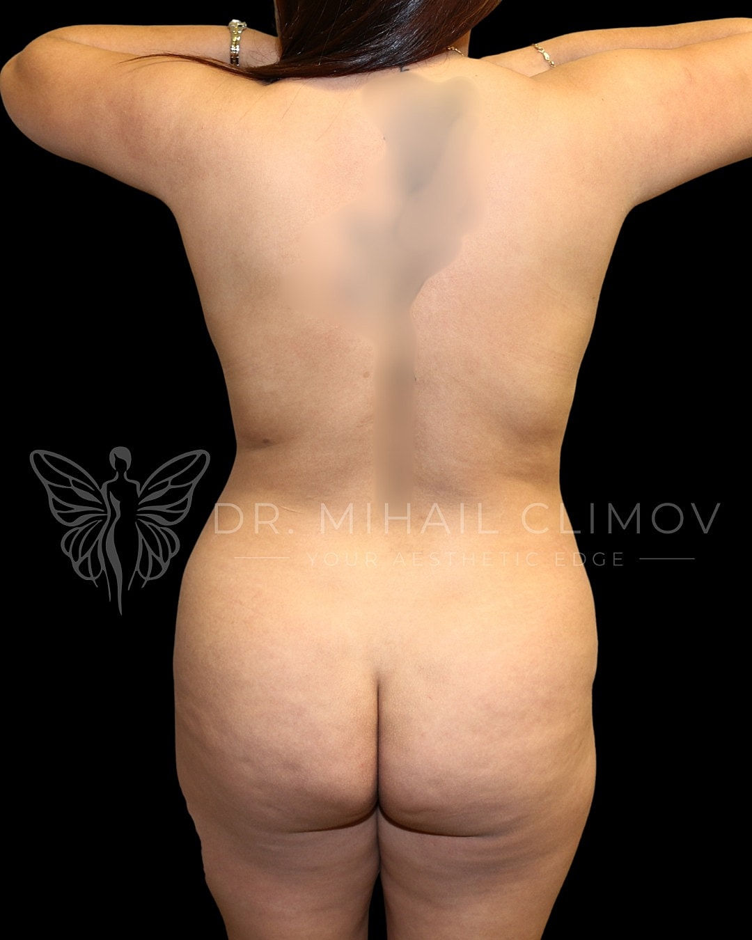 Rear view of a person’s torso.