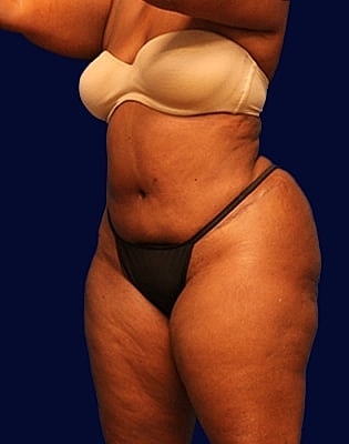 Abdominoplasty Before & After