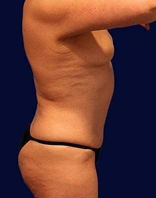 Abdominoplasty Before & After