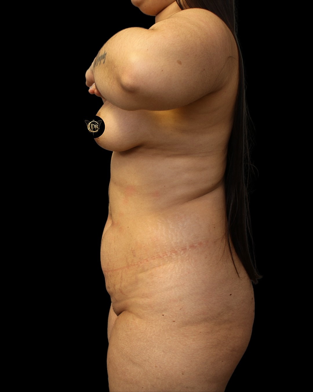Abdominoplasty Before & After