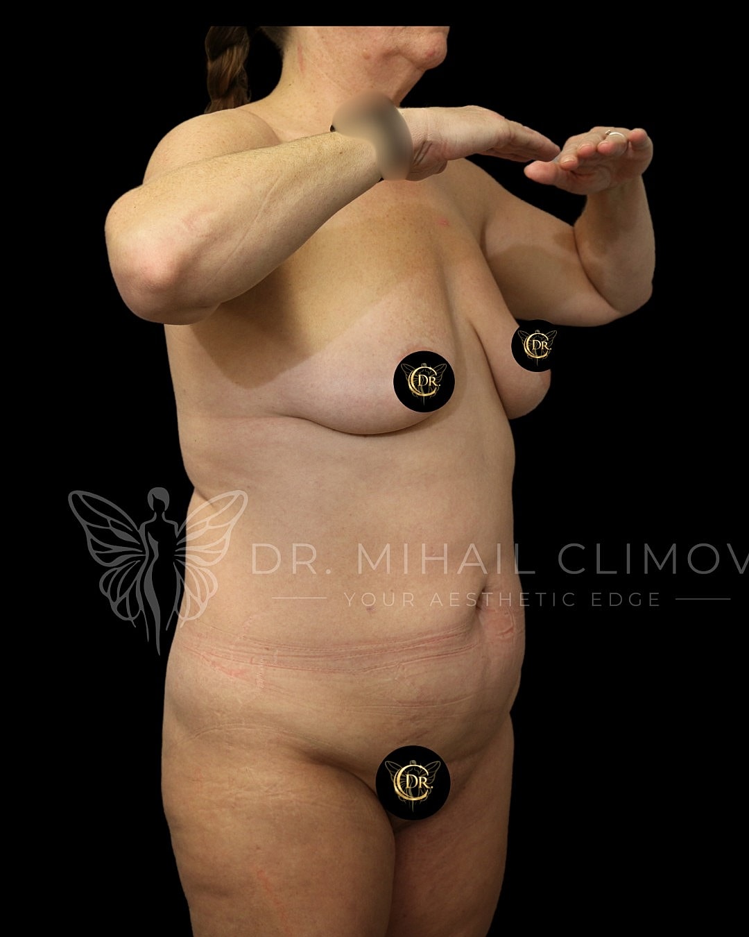Abdominoplasty Before & After