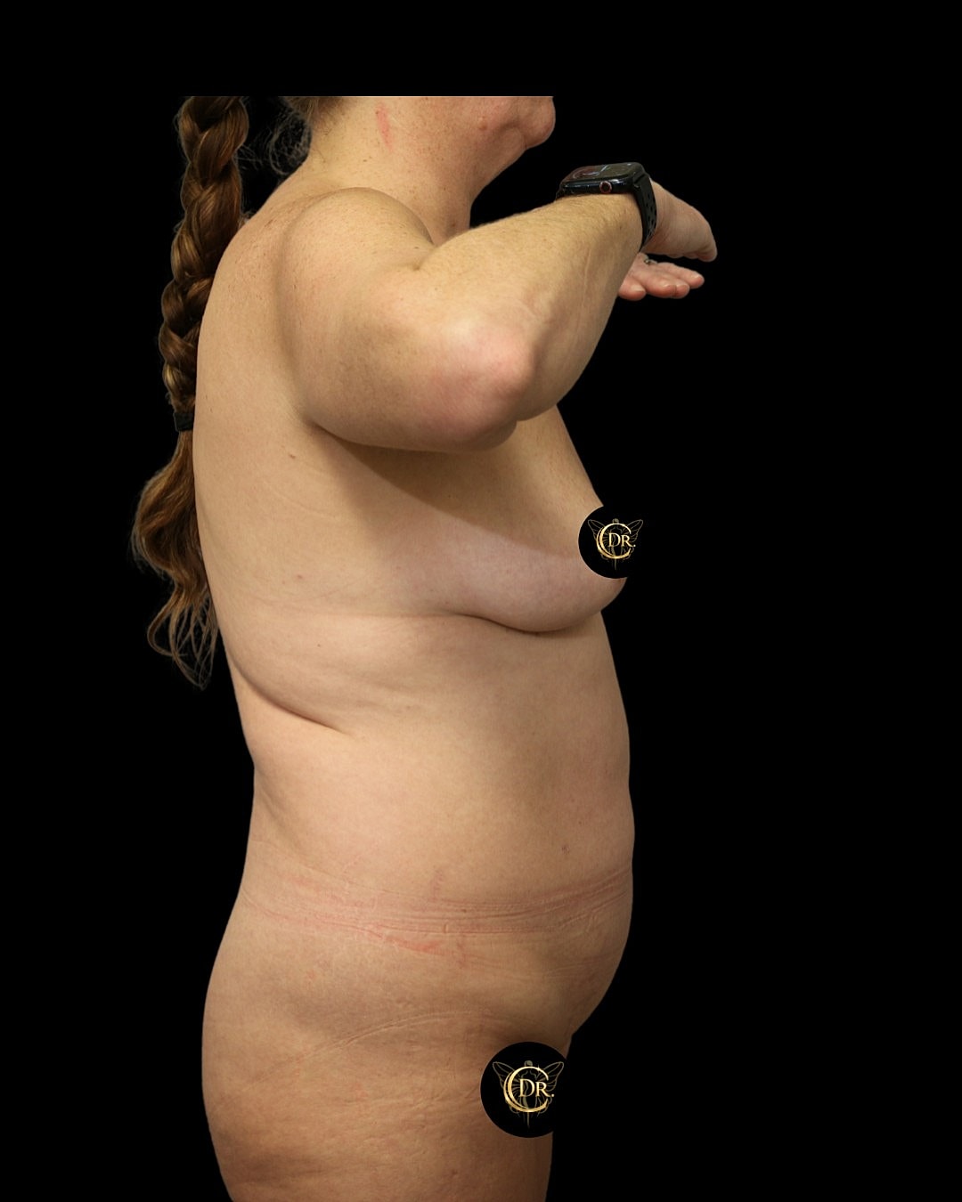 Abdominoplasty Before & After